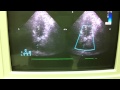 OPTOMIZE COLOR DOPPLER in ultrasound philips 7500 part 6