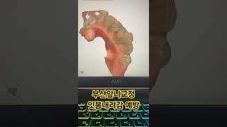 부산앞니교정 잇몸내려감 예방