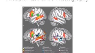 diffusion tensor imaging