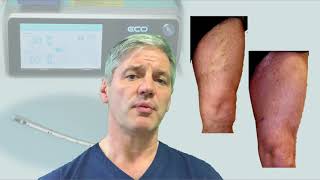 Endovenous Microwave Ablation of Varicose Veins