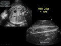 Mistakes to Avoid in the 2nd and 3rd Trimesters Fetal Anatomy and Measurement