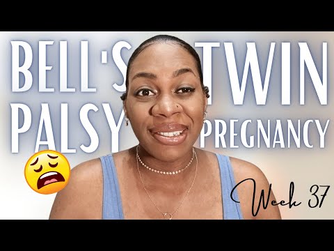 I HAVE BELL&#39;S PALSY | DIAGNOSED WITH BELL&#39;S PALSY AT 37 WEEKS PREGNANT