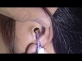 Top 3 Girl's Massive Impacted Earwax Removal