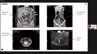 Đánh giá bệnh Crohn trước điều trị - CME UMC 30.09.23 - P2