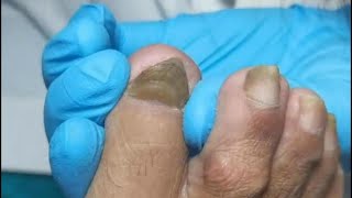 Have you ever seen triangular nails? Fungal nail treatment &amp; ingrown toenails removal.