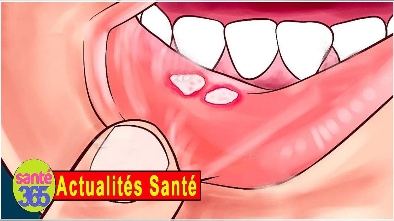 Comment Enlever Un Aphte En 5 Minutes