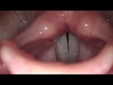 Stroboscopy: Normal Female Vocal Cords