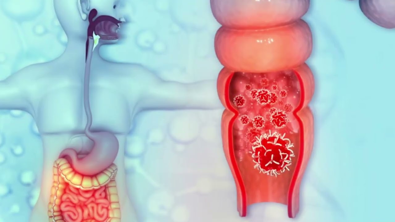 Cáncer de recto. Detalles importantes que debes saber
