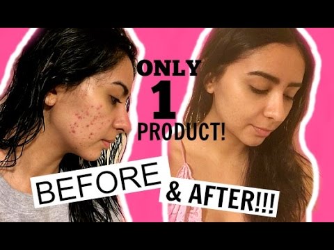 HOW I CLEARED MY ACNE IN  WEEKS!! BEFORE AND AFTER PICS!