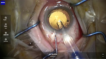Secondary sulcus intraocular lens surgery explained for patients