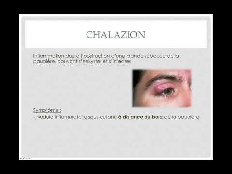 Vidéo: Morel Est Un Ophtalmologiste Naturel
