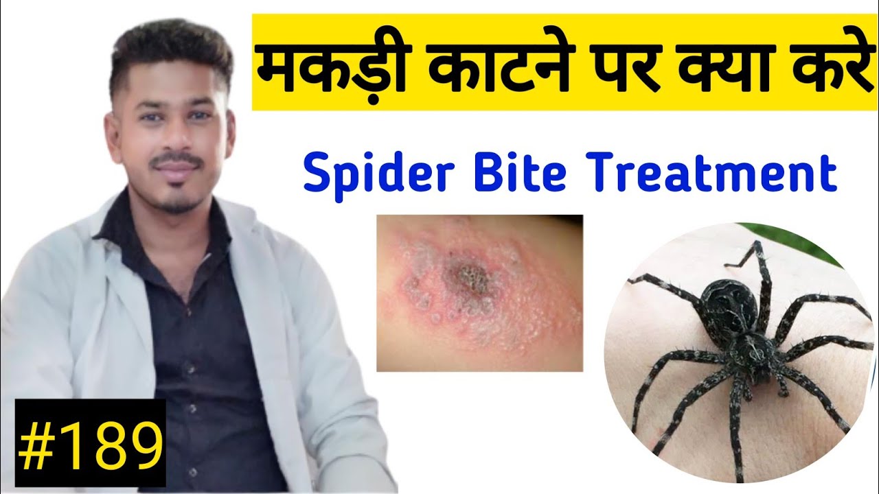 मकड़ी के काटने पर क्या करें Primary Treatment Of Spider Bite Spider