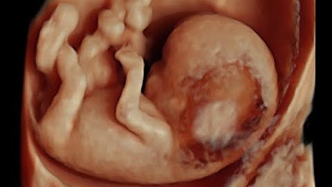 Increased Nuchal Translucency