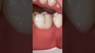 Class II MOD lower first molar Instagram Live 6 April 2020 Part 2