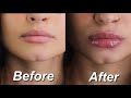 The BEST at home lip plumping mask 💋*ONLY 3 INGREDIENTS* insane results!!!
