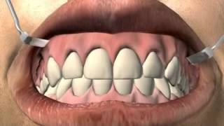 What is a tooth fistula?
