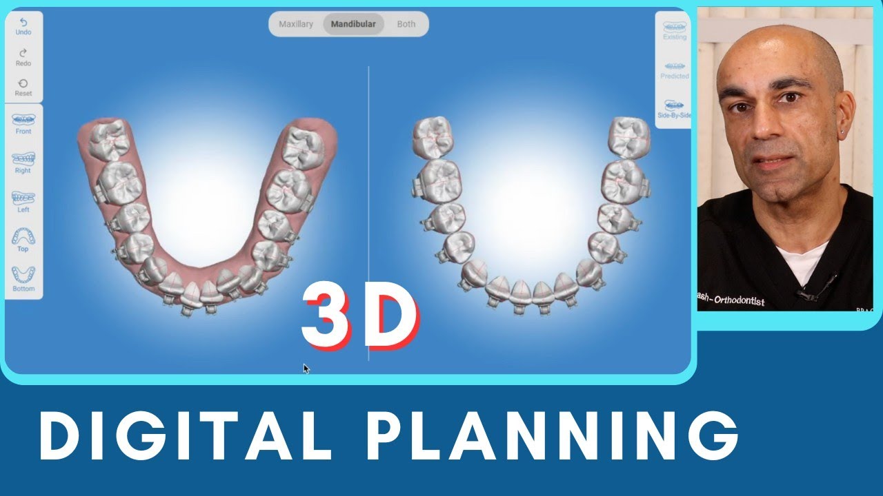 How To Plan Braces Treatment with 3D Digital Planning - YouTube