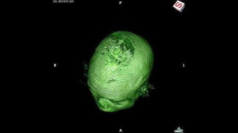 Brain MRI 3D Reconstruction