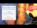 Correct wound VAC technique-- @DrArthurMiami -- negative Pressure wound therapy -- limb salvage