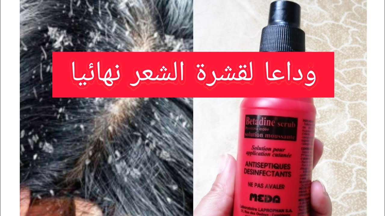 🚨التخلص من قشرة الشعر/الحكة الشعر/جروح/ بسرعة بمكون واحد فقط👌