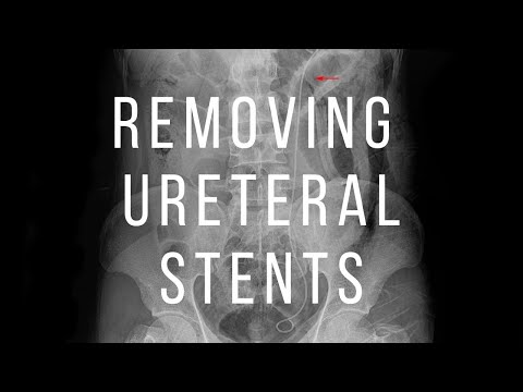 Removing Ureteral Stent in 15 Seconds #shorts