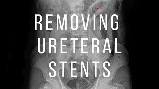 Removing Ureteral Stent In 15 Seconds 