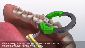 Using the Triodent V3 System
