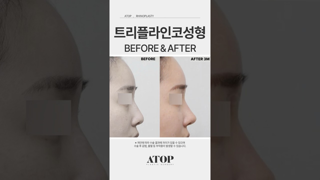 [Эйтоп гоо сайхны эмнэлэг] Трипл Лайн Хамрын гоо сайхны мэс засал_Сэтгэгдэл 4 #ЭйтопГооСайхныЭмнэлэг #ГаннамГооСайхныЭмнэлэг #ХамрынМэсЗаслыгСайнХийдэгГазар