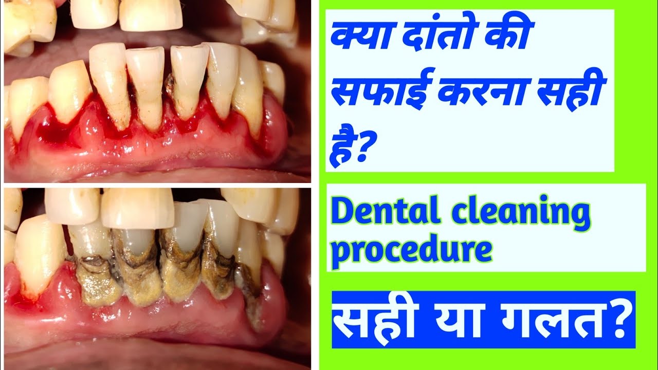 दांतो की सफाई ⚫️Dental cleaning procedure⚫️क्या दांतो की सफाई करना सही