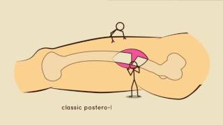 Fassier-Duval Telescopic IM System by OrthoPediatrics Canada