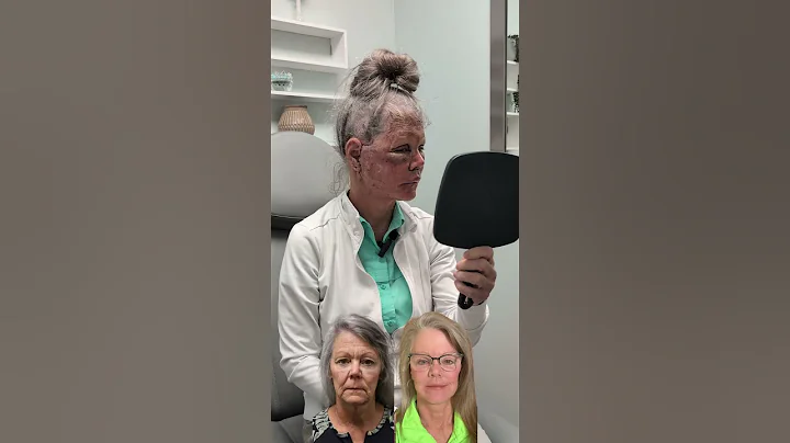 24 Hours Post-Op: Unwrapping (Deep Plane Facelift, Neck Lift, Lip Lift, Upper Blepharoplasty)