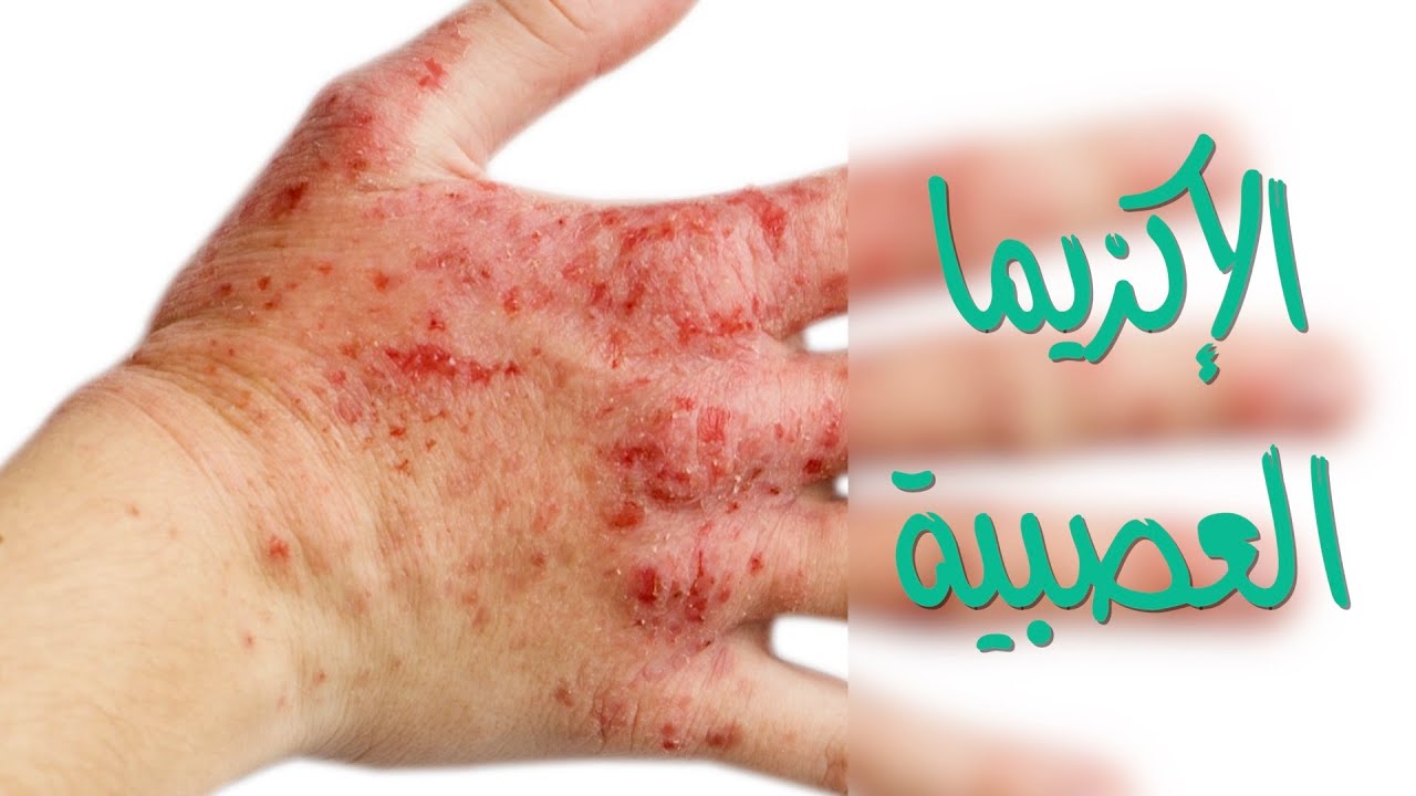 الإكزيما العصبية، الأسباب وطرق العلاج