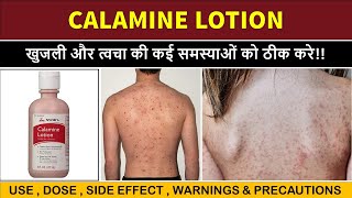 calamine lotion uses | खुजली के लिए बेस्ट लोशन | itching , scabies etc. screenshot 2