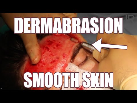 Dermabrasion for Smooth Skin, Acne Scars Treatment, and Smaller Pores