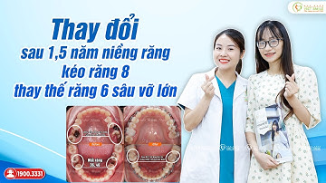 PT sự thay đổi sau 1,5 năm niềng kéo răng 8 thay thế R6 sâu