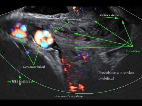 Procubitus du cordon ombilical (cordon ombilical praevia) -  37 SA