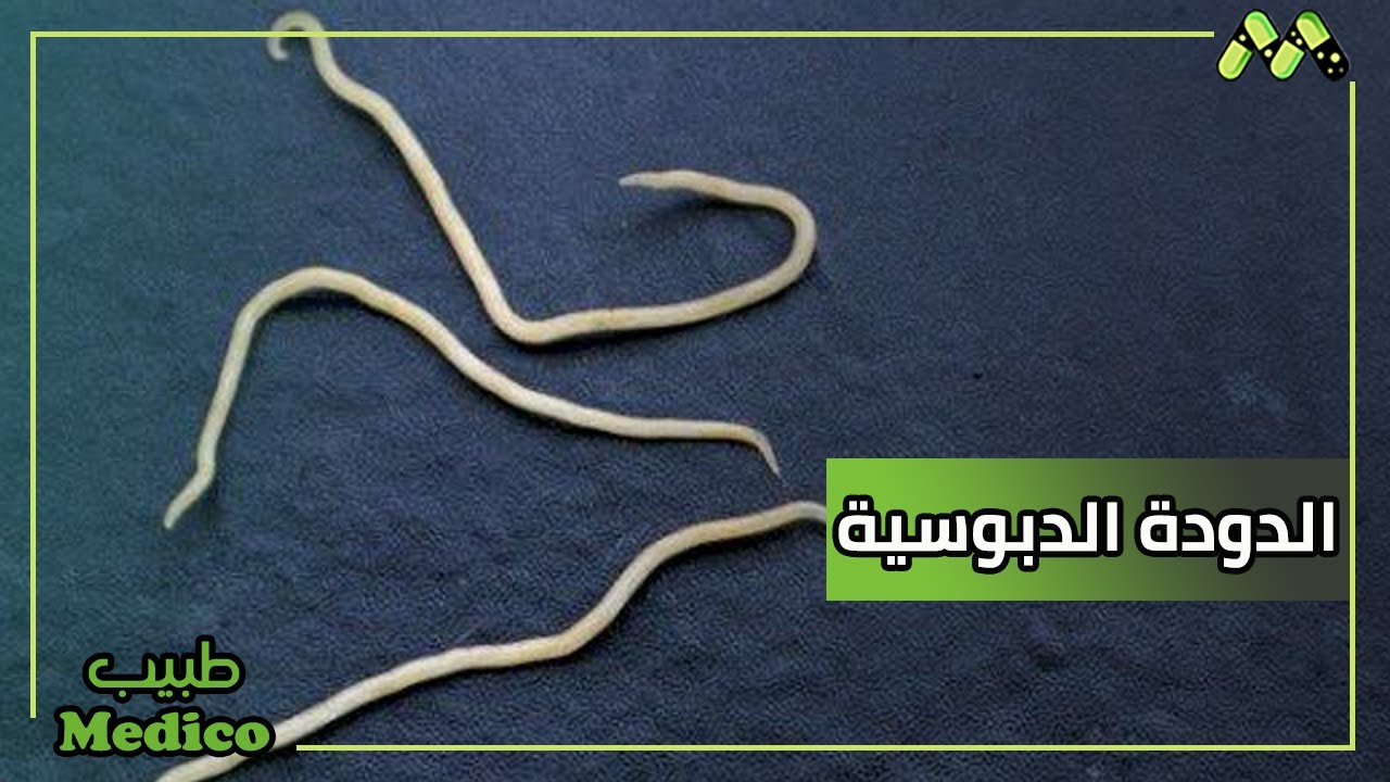 عدوى الدودة الدبوسية خاصة عند الأطفال وكيفيه علاجها - YouTube