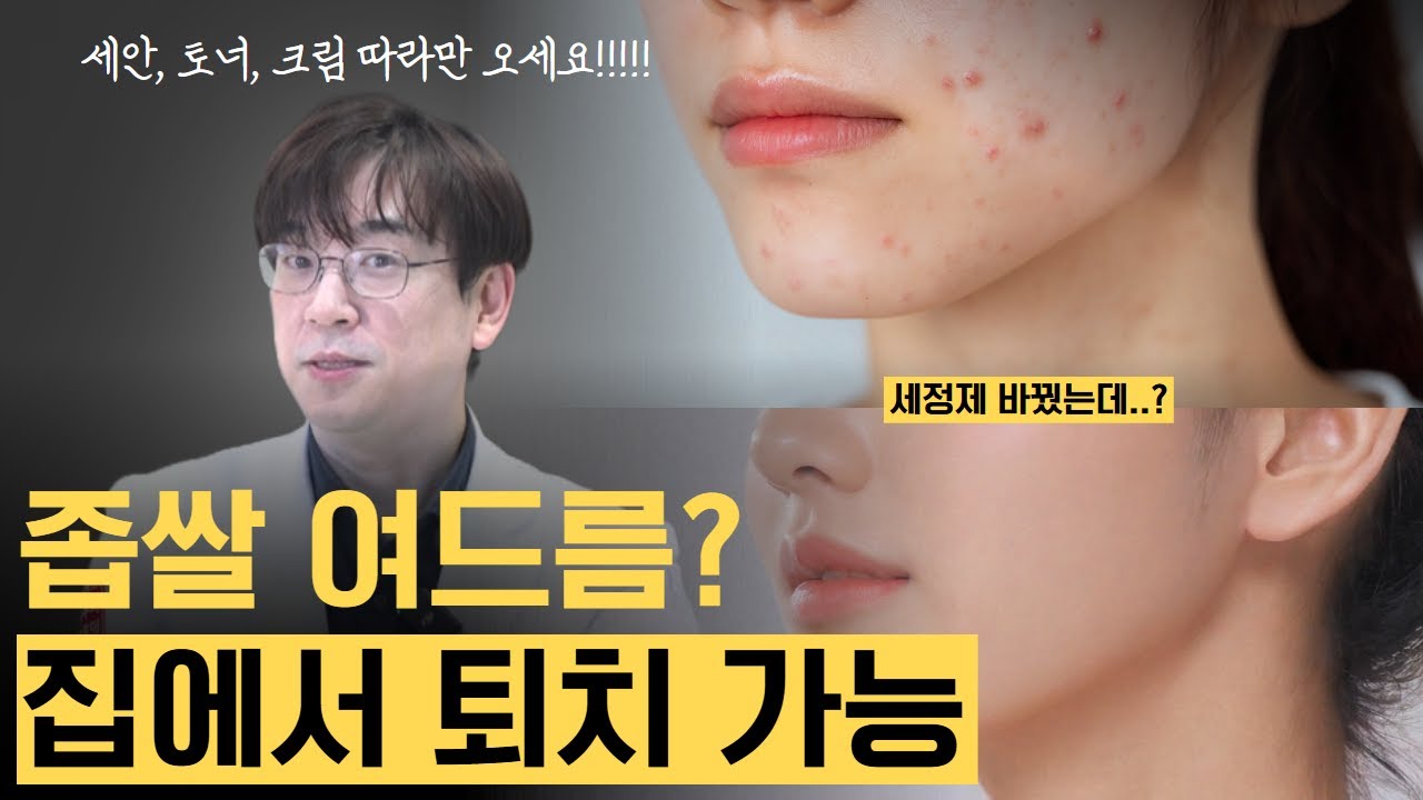 좁쌀여드름 고민? 홈케어로 해결! 피부과 전문의가 알려줍니다. 세안, 토너 싹 바꾸세요. 제품 추천도! ㅣ 손현호의 베스트피부