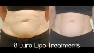 Laser Lipo Before And After Video Laser Lipo Before And After Video