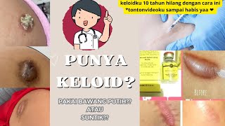 Menghilangkan KELOID Pakai Bawang Putih? Jangan ❌ pakai cara ini aja  yah