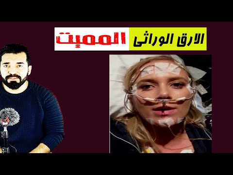 الارق الوراثي المميت | مرض نادر || تقدر تعيش قد اية من غير نوم