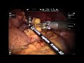 Indications for Pancreatic Resection and Robotic Surgical Technique | Brigham and Women's Hospital