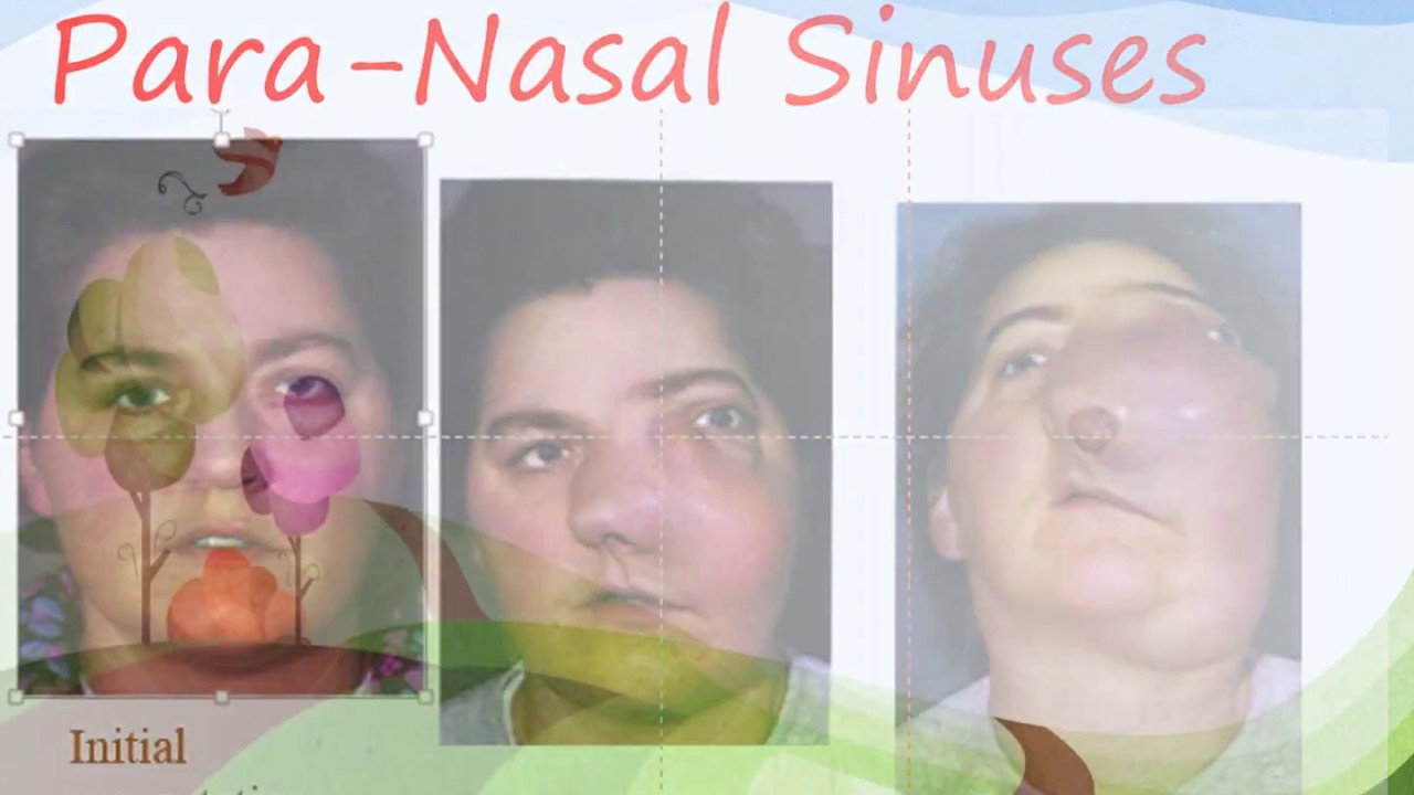 Tumors of Nose and Para Nasal Sinuses I Dental Guide I Dr. Bimal Chand I