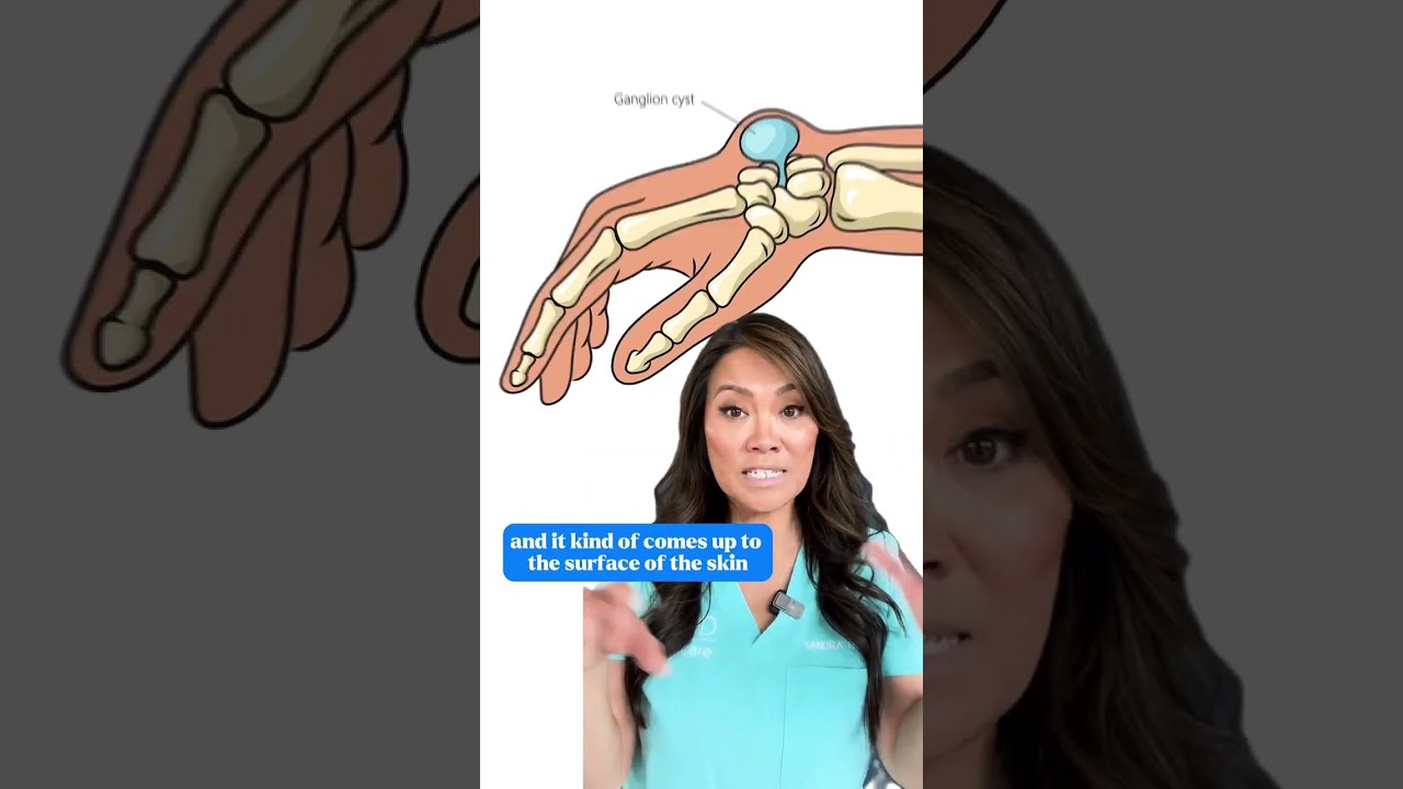 Have You Heard Of The Bible Cyst Aka Ganglion Cysts 