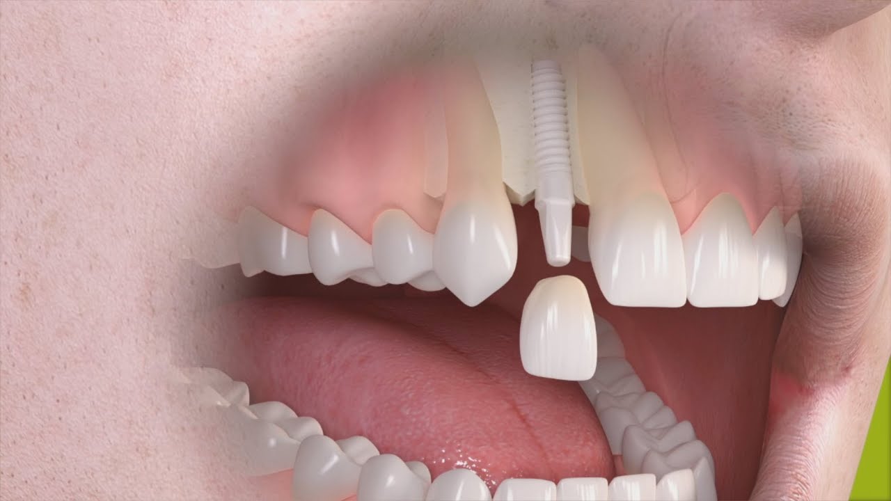 Momentum Downtown warm Straumann - Implantaatbehandeling bij een ontbrekende tand met een  keramisch implantaat - YouTube