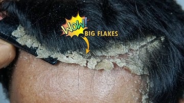 Itchy Dry Scalp Scratching Dandruff On Front Side #1138