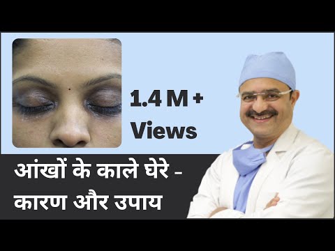 आंखों के काले घेरे - कारण और उपाय (Under Eye Dark Circles: Causes & Treatments) | (In HINDI)