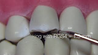 Porcelain Fused to Metal Crown Preparation  PFM Canine