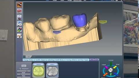 E4D eMax PlanScan 4 - Posterior Dental Implants