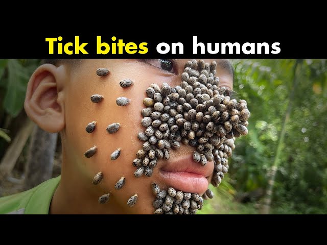 What happens if a human is bitten by a tick? (Urdu/Hindi) - YouTube